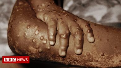 Monkey pox: Is it time to worry or ignore?