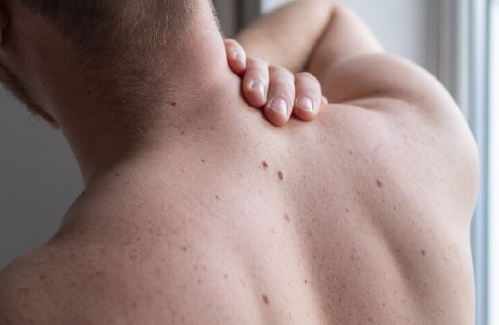 Moles on the body can also be a symptom of melanoma Men have more than women